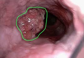 lung cancer.jpg